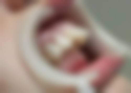 牙齿怎样种植牙的视频中的三等甲医院：全流程规范操作与优势分析