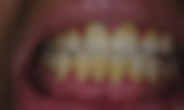 全口即刻种植牙的原理揭秘