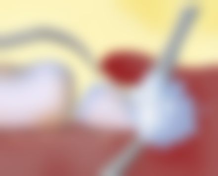 半口种植牙齿夜间护齿的必要性