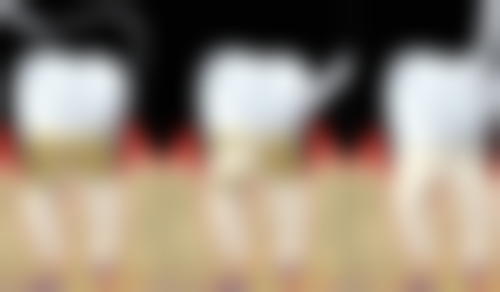 60以上老人种植牙5个必知护理要点——悉心呵护，长久相伴