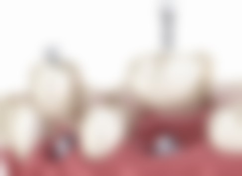 士卓曼种植牙40年寿命是怎么样的：实验室数据与现实使用差异