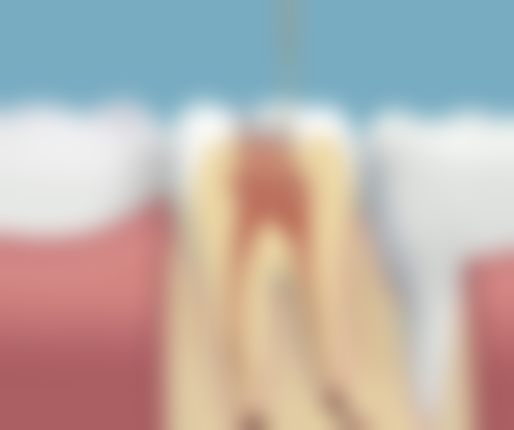 进口与国产种植牙大PK:各有优势如何抉择