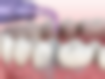 拔牙之后种植牙需要多久——即刻种植：40 分钟极速体验的“精装房”