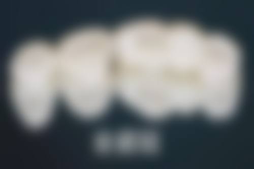 年轻人种植牙与镶牙寿命较量:探寻持久陪伴者