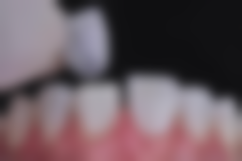 安阳北关添悦口腔门诊部刘学敏手术成功几率——安阳添悦口腔