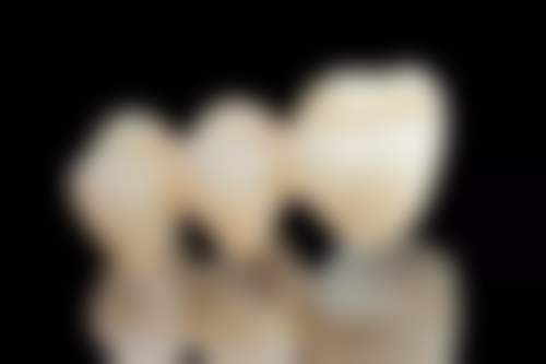 种植牙需要牙神经吗？单颗/全口种植牙神经处理大揭秘