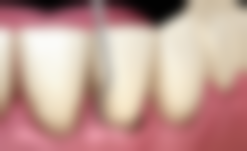 拔牙后 3 - 6 个月传统延期种植——稳妥的“马拉松选手”策略