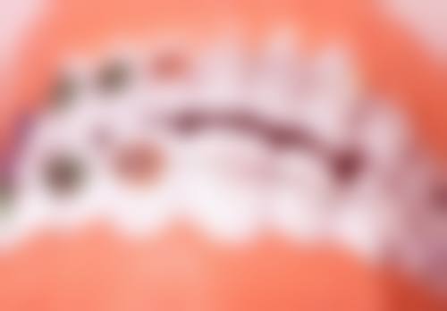 不同医院视角下老人种牙价目表——从经济实惠到高端品质