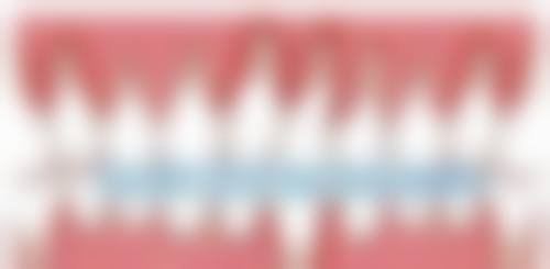 种植牙拆线之后多久可以装牙冠:临时牙冠的过渡作用