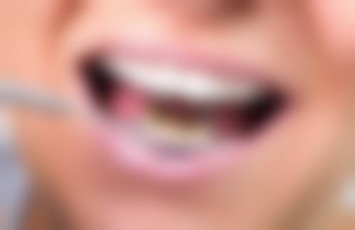 单颗种植牙当天完成的可能性——即刻种植的明星典范