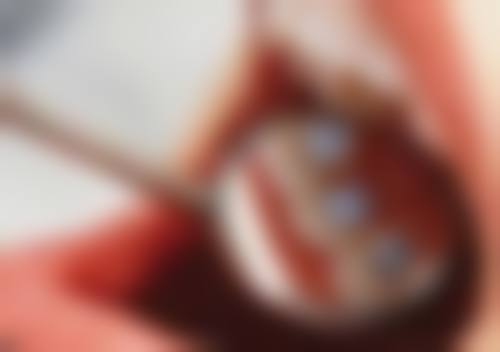 不同需求下性价比高的种植牙品牌推荐：精细匹配你的选择