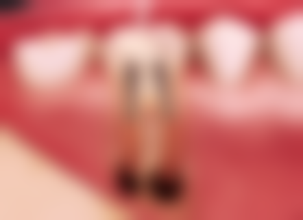 拔牙后一定要种植牙吗——种植牙为什么被医生“强推”？