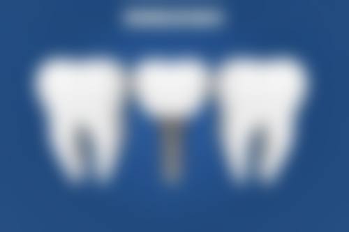 七十岁以上老人能种植牙齿吗：注意事项成就长久好牙