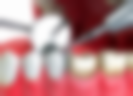 拔了牙齿后种植牙齿的好处：智齿不参与