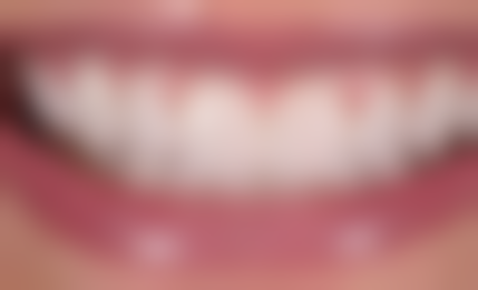 皓圣种植牙品牌所属国内：技术无国界的口腔解决方案