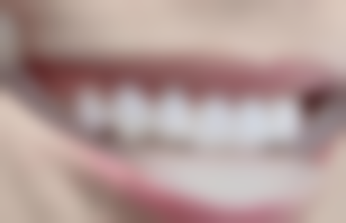 烤瓷牙和种植牙寿命较量：谁能陪你更久？