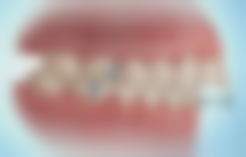 烤瓷牙和种植牙安心性评估：谁更让人放心？