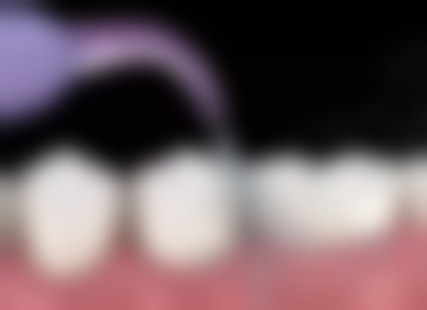 烤瓷牙和种植牙美观度PK：谁的微笑更迷人？