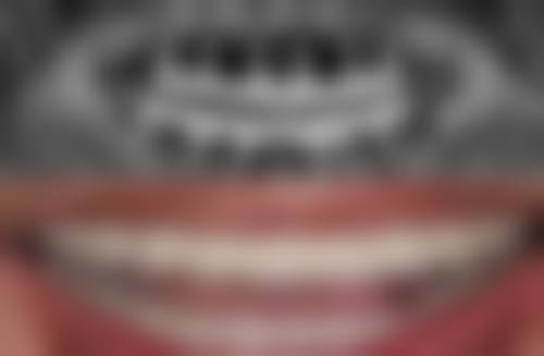 种植牙牙冠保质期受哪些因素影响