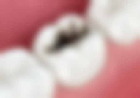 全口种植牙的过程是怎样的——种植体植入阶段