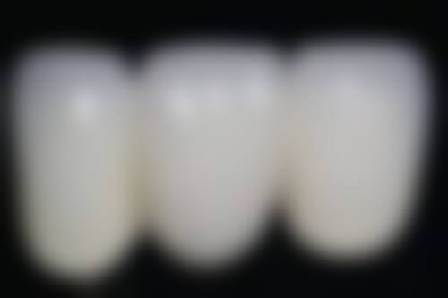 60岁以上种牙成功几率：科技护航下的高保护