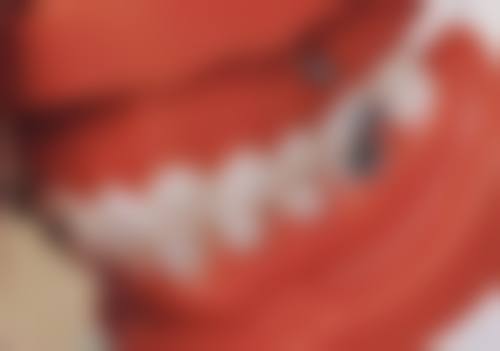 60岁以上种牙费用：全透明解析