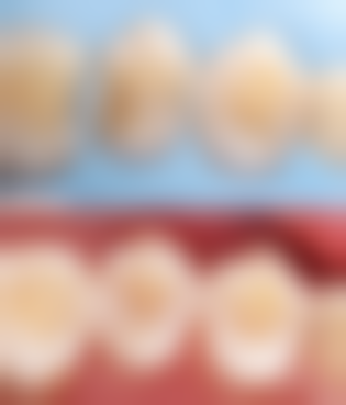 全口种植牙种植体植入要花费多少时间