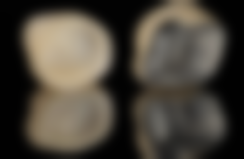 韩国种植牙与瑞典种植牙哪个好：适用人群各不同