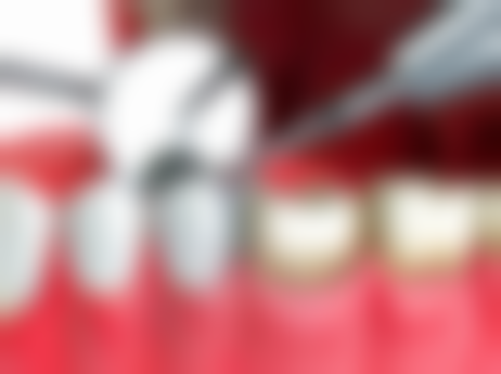 哪些精神疾病患者不能种植牙