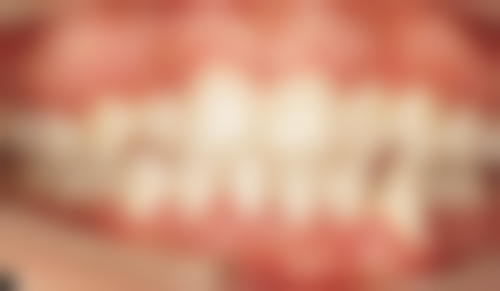 牙齿搭桥跟种植牙哪个好:使用寿命大比拼