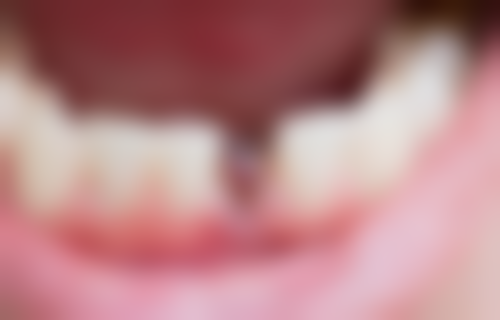 北京维乐口腔门诊部（方庄店）姚二雷做的手术怎么样——北京诚之康口腔门诊