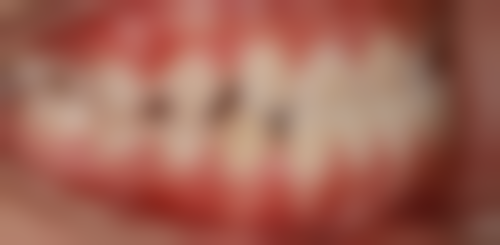 牙冠和种植牙什么区别——材质大解析