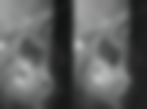 活动义齿和种植牙后遗症之功能修复对比