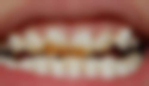 什么季节种植牙更好更安心之夏季种牙营养足优势剖析