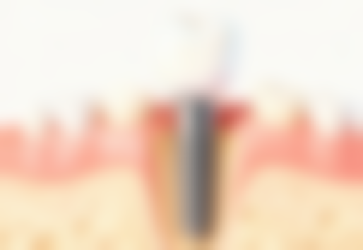 适合老年人的种植牙品牌:关怀老年人的口腔健康