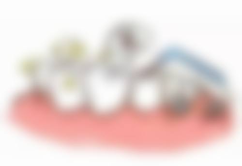 种植牙如何安装牙冠之材料选择：避开陷阱，省心省钱