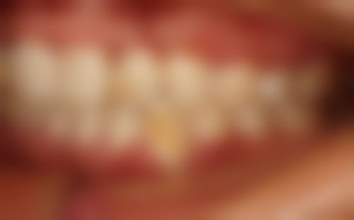 老年人种植牙齿好吗——延年益寿的秘诀:种植牙术后护理指南