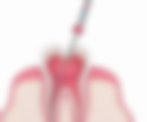 登腾种植牙：性价比更高的“国民品牌”医院实测优势与价格