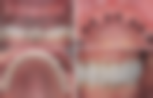 柏德口腔薛启明医生：德国ACM种植牙2980元的技术补贴