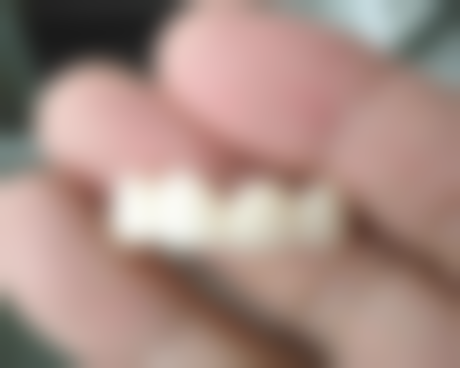 60岁种植牙齿的5大风险与应对策略之术后维护挑战:60岁种牙术后如何做好维护?