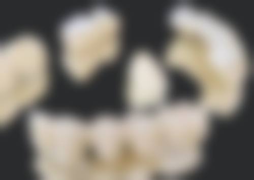 种植牙有什么坏处吗——使用寿命真相剖析