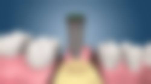 全口种植牙种植体稳固吗？——守护种植体的“稳定城堡”