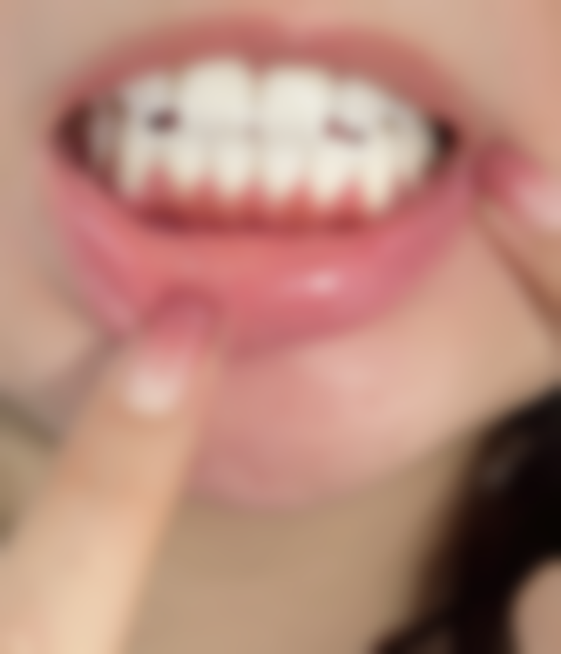 全口种植牙牙槽骨会稳定吗？——筑牢种植体的“坚实地基”