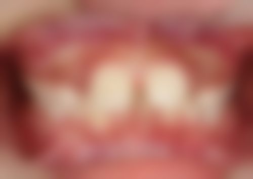 60岁以上老人种植牙的费用考量：投资健康，物有所值