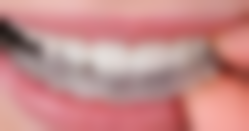 安装假牙和种植牙齿哪个好——适用人群全解析