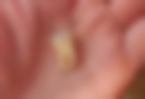 种植牙冠粘贴方式有哪些:多样选择看这里