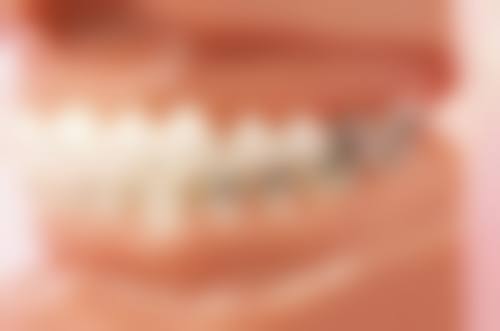 活动义齿和种植牙有什么区别——维护方式：勤快主人VS轻松生活