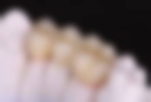 拔牙以后可以不种植吗：不种牙的替代方案