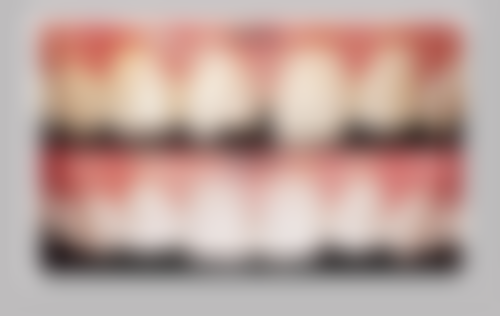 种植牙的牙冠耐用性比拼：谁能笑到末尾？