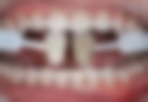 拔牙后可以马上种植牙吗?:价格大揭秘:从经济型到豪华版